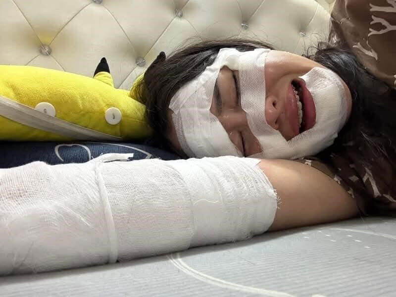 Hidrojen Balonunun Patlaması Sonrası Vietnam’da Doğum Günü Kutlaması Kâbusa Döndü Hanoi'de Giang adlı kadın, doğum günü sırasında hidrojen balonunun patlaması