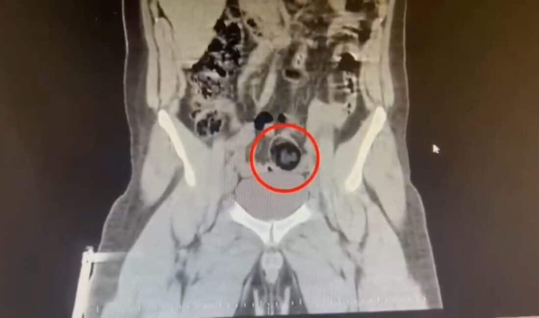 Kars’ta Yolcu Otobüsünde Yakalanan İranlı Kurye, Makatından 105 Gram Metamfetamin İle Gözaltına Alındı Kars'ta durdurulan bir yolcu otobüsünde, İran uyruklu kurye gözaltına alındı.