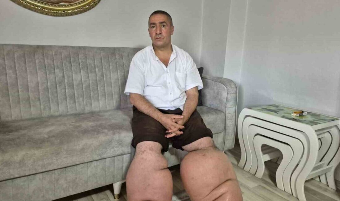 Seyfettin Taşcı, 15 yıl önce fil hastalığı nedeniyle yaşamı zorlaşan