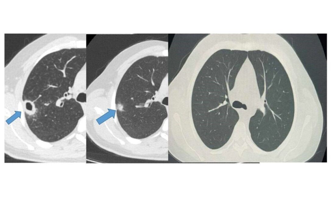 Bayburt Devlet Hastanesi'ne öksürük ve balgam şikayetiyle başvuran 50 yaşındaki