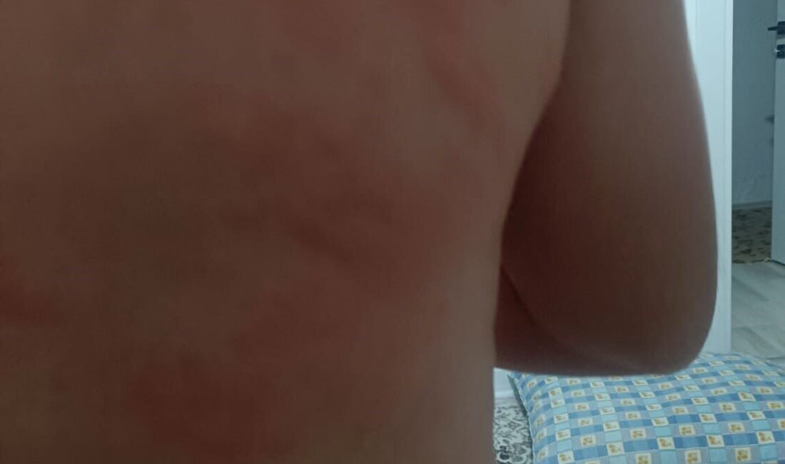 Elazığ’ın Karakoçan ilçesinde N.Ö., iş yerinde böcek ısırması sonucu hastaneye