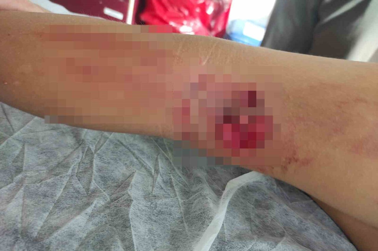 Yeni Sölöz Mahallesi’nde 8 yaşındaki çocuğa sokak köpeği saldırdı, hastaneye kaldırıldı