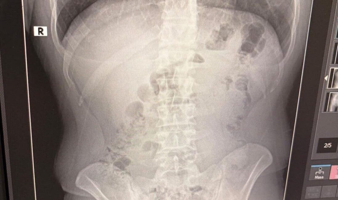 Uşak’ta İran Uyruklu 3 Şahsın Evinde ve Midelerinde 1 Kilogramdan Fazla Metamfetamin Bulundu Uşak'ta uyuşturucu ticareti yaptıkları tespit edilen İran uyruklu Y.T., A.T.