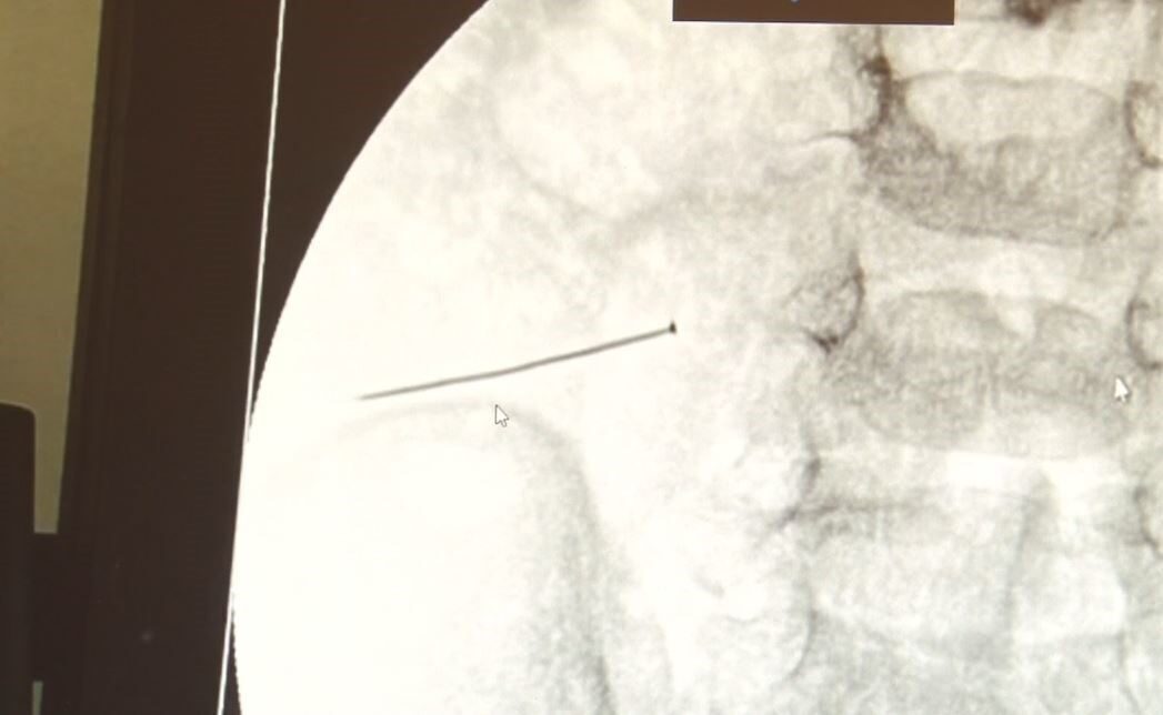 İstanbul'da 2 yaşındaki bir çocuk, 3 santimlik toplu iğne yutması