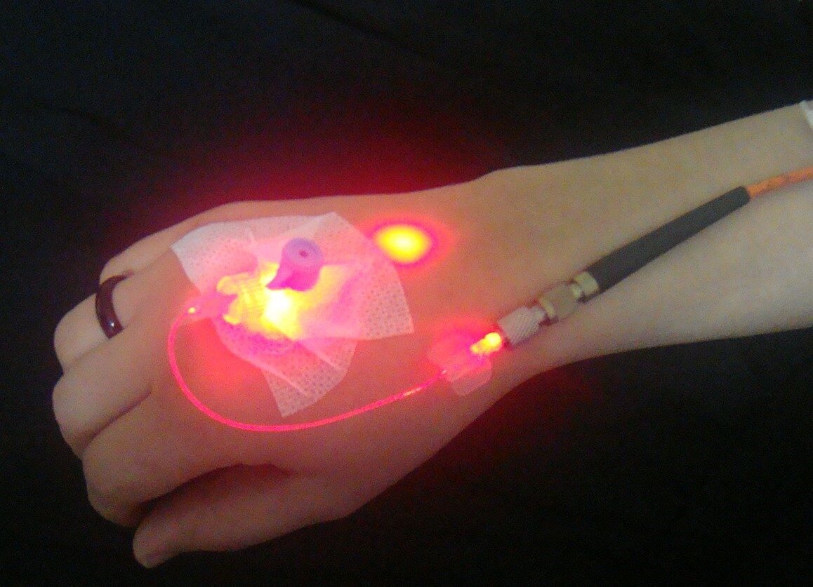 Yaz aylarında ortaya çıkabilen tek bacak veya kol şişlikleri, lenfödemin