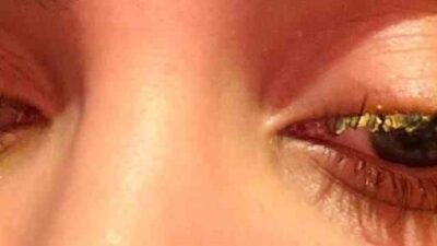 İstanbul Esenyurt'ta Dilara Çalışkan, güzellik salonunda kirpik yaptırırken hatalı işlem