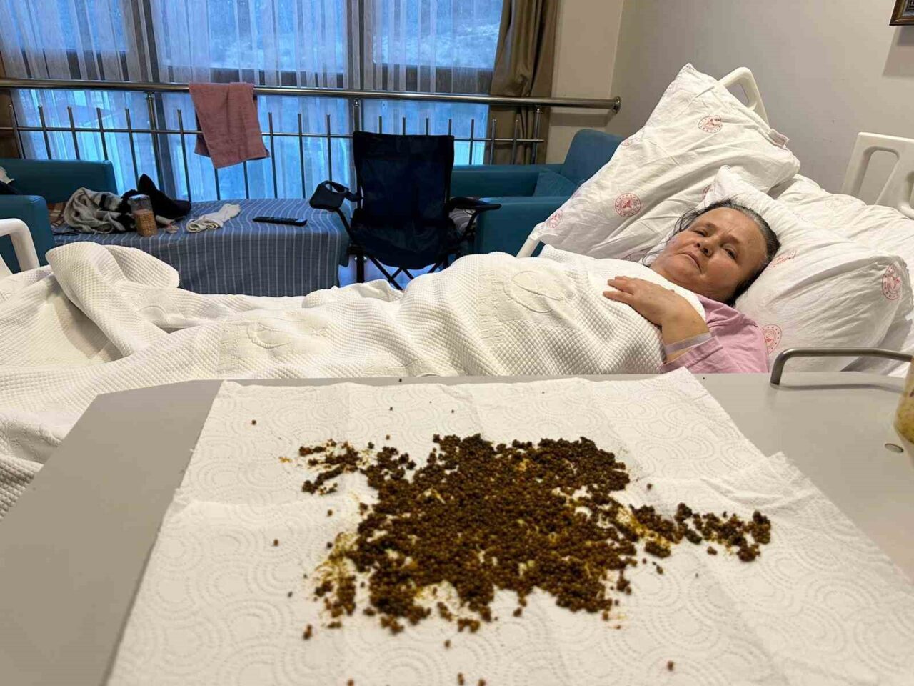 Manisa’nın Soma ilçesinde 70 yaşındaki Ayşe Çobanlar’ın safra kesesinden 20