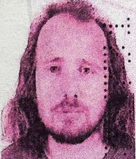 İngiliz vatandaşı Mentor Rama, saç ekimi ve ardından diş tedavisi