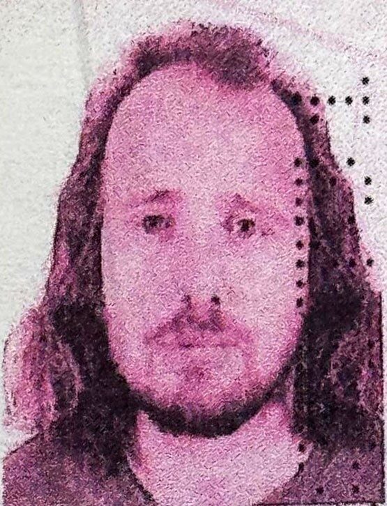 İngiliz vatandaşı Mentor Rama, saç ekimi ve ardından diş tedavisi