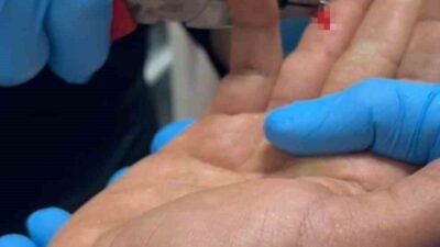 Adıyaman’ın Kahta ilçesinde balık tutarken parmağına iğne batan S.D., hastaneye