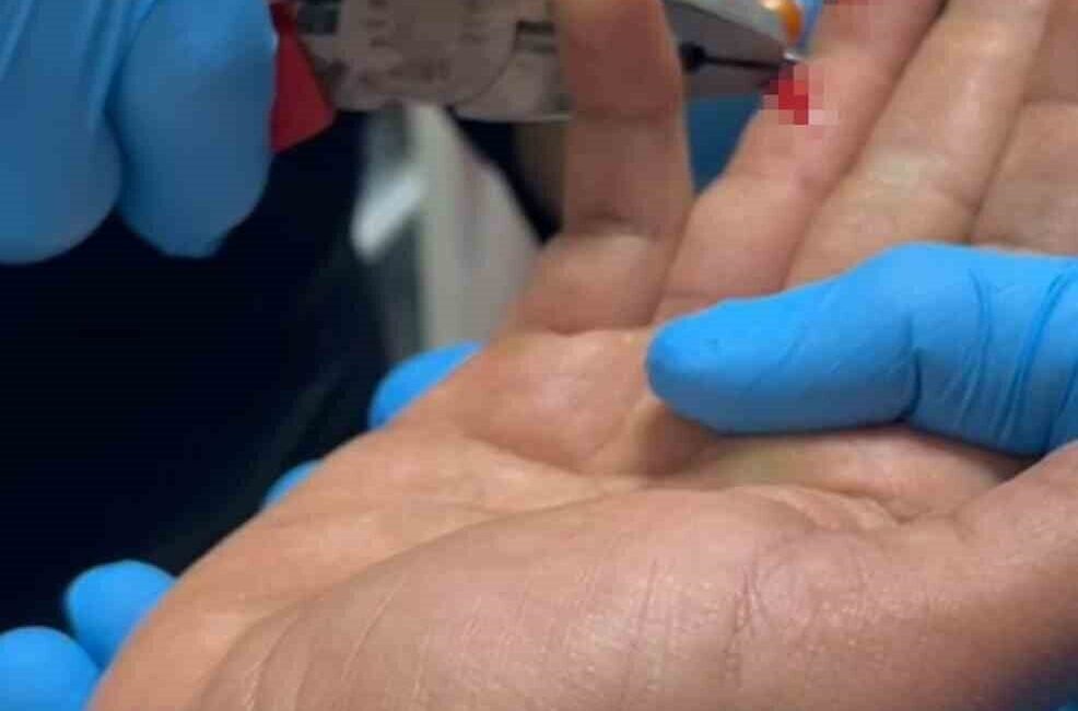 Adıyaman’ın Kahta ilçesinde balık tutarken parmağına iğne batan S.D., hastaneye