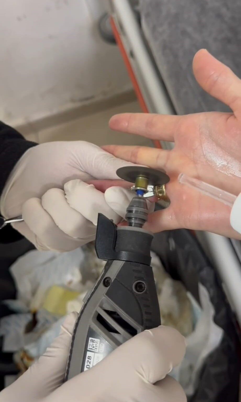 Batman'da parmağına sıkışan iki yüzüğü çıkaramayan bir kadın, hastaneye başvurdu.