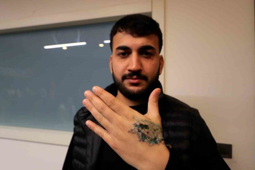 Güzellik merkezinde dövme sildirirken elinde yanık oluşan Yasin Taş, şikayetçi olacak.