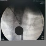 Siirt’te 8 yaşındaki çocuk, boğazına kaçan madeni para sayesinde hastanede kurtarıldı.