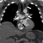 Prof. Dr. Nevzat Karabulut’tan kalpteki gizli deliklerin tehlikelerini ortaya koyan çalışma.