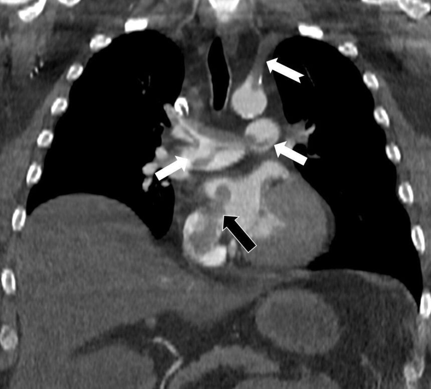 Prof. Dr. Nevzat Karabulut’tan kalpteki gizli deliklerin tehlikelerini ortaya koyan çalışma. Prof. Dr. Nevzat Karabulut’tan kalpteki gizli deliklerin tehlikelerini ortaya koyan çalışma.